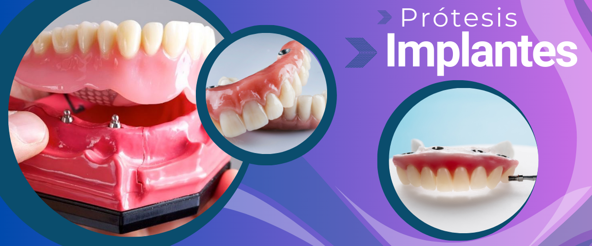 Imagen trabao implantes para pagina Inicio Inspira dental Laboratorio